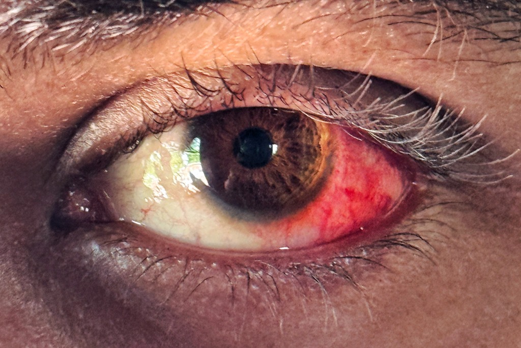 Blind Man. One Good Eye.